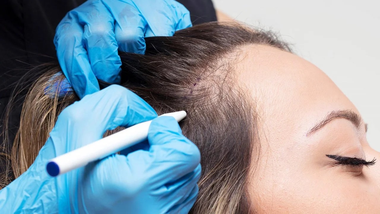Hair transplant Istanbul for High Precision Hair Transplants